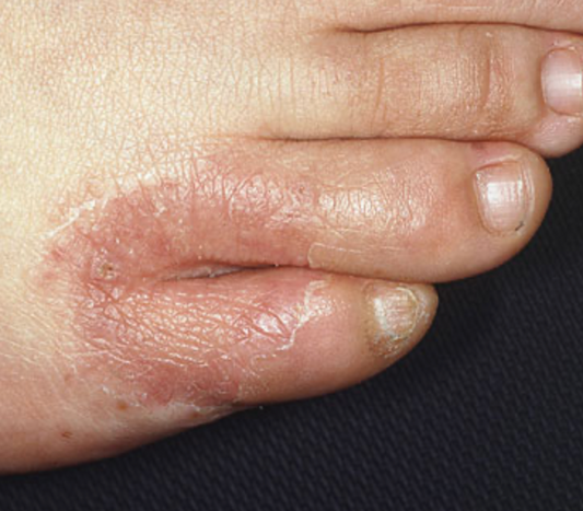 Fungal Woes: Recognizing and Treating Common Foot Infections with DiabeticShoes"