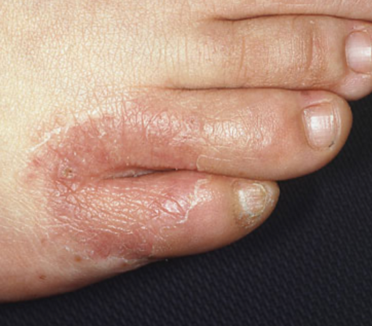 Fungal Woes: Recognizing and Treating Common Foot Infections with DiabeticShoes" - Diabetic Shoe - An Ortho Shoes Company