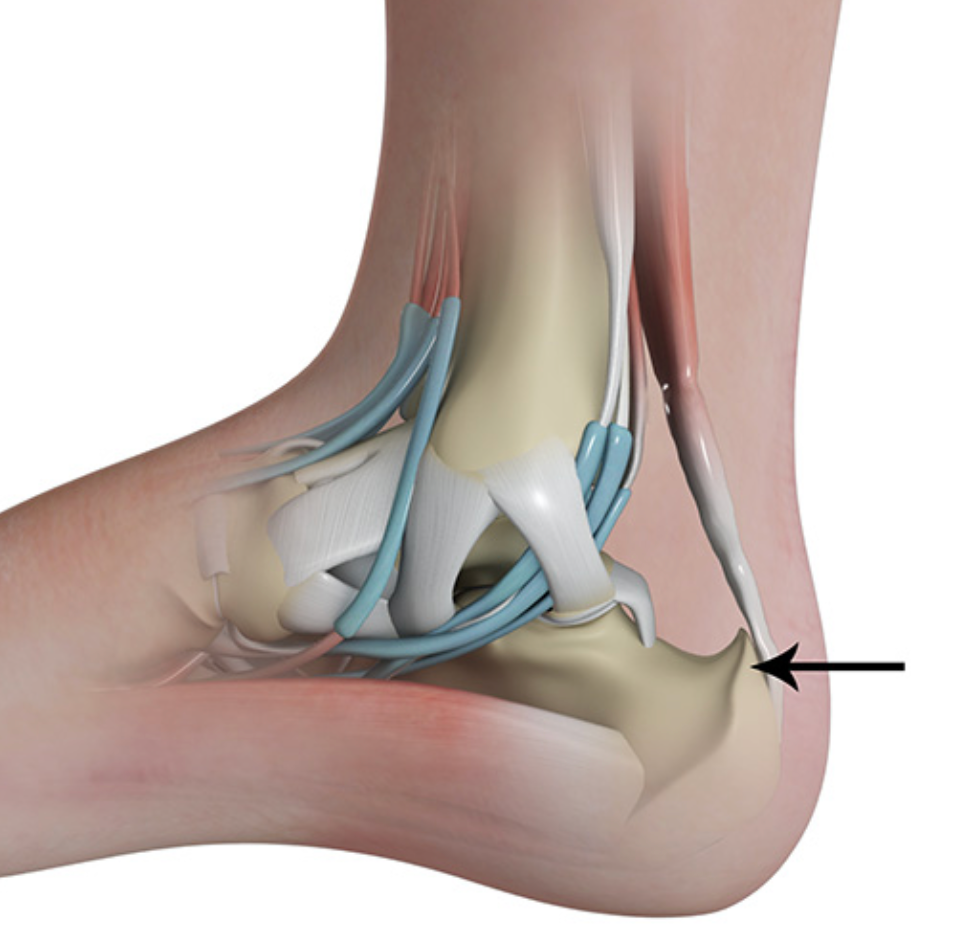 Understanding Haglund's Deformity: Causes and Treatment - Diabetic Shoe - An Ortho Shoes Company