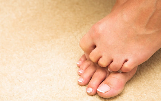 Effective Ways to Treat and Prevent Hammer Toe