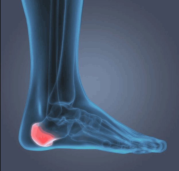How to Heal Heel Pain Naturally