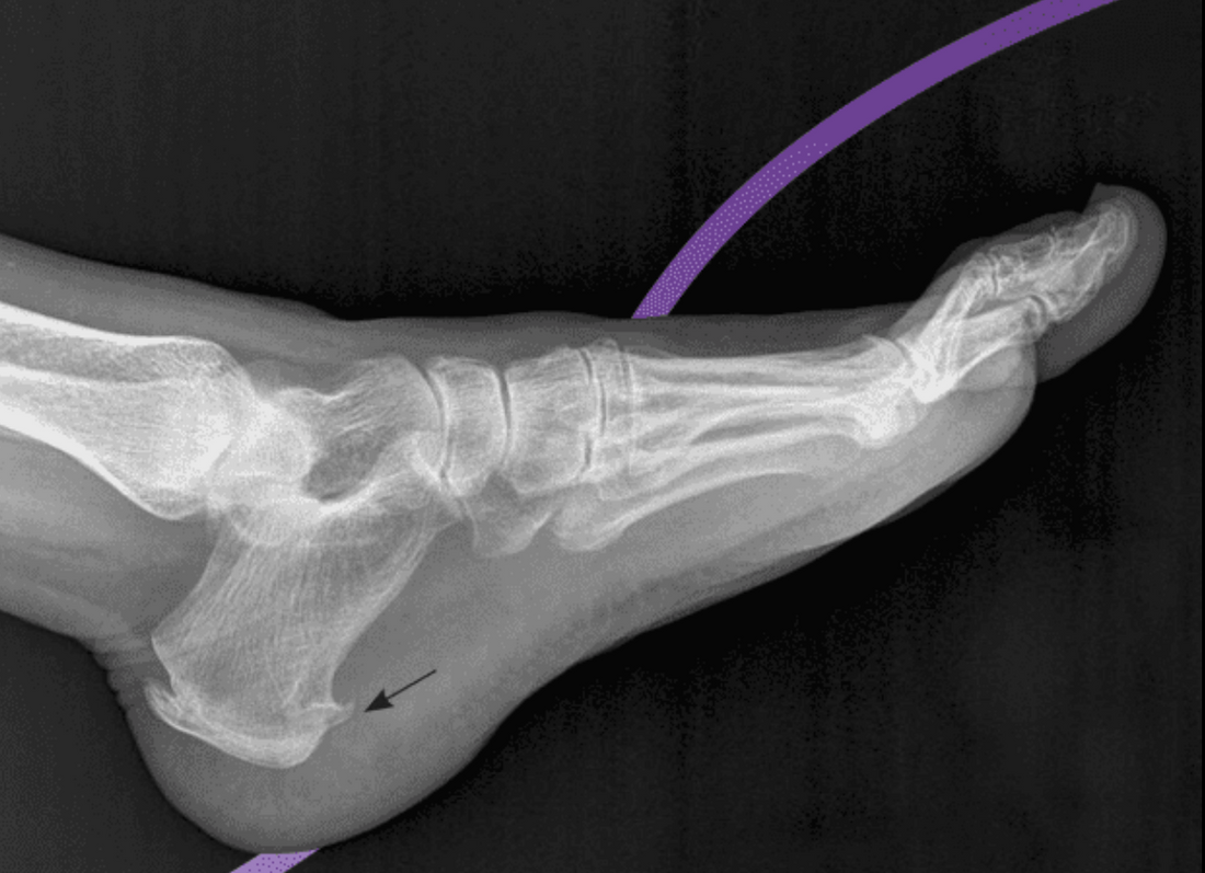 Understanding Heel Spurs: Symptoms and Causes - Diabetic Shoe - An Ortho Shoes Company