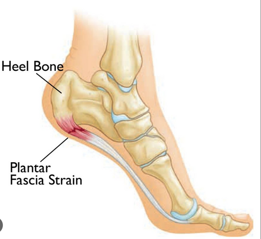 Finding Relief: Medicated Footwear for Heel Pain