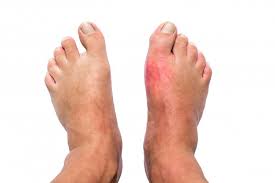 IMPACT OF HIGH BLOOD SUGAR ON FOOT HEALTH