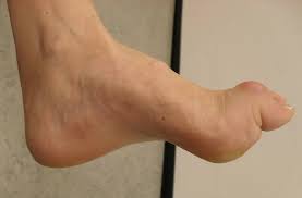 Understanding HMSN Disease: Symptoms and Treatments