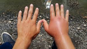 Causes and Remedies for Hand Swelling