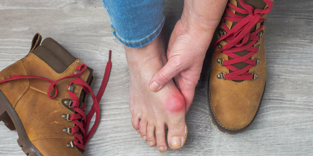 Bunions Unveiled: Understanding the Unwelcome Guests at Your Toes - Diabetic Shoe - An Ortho Shoes Company
