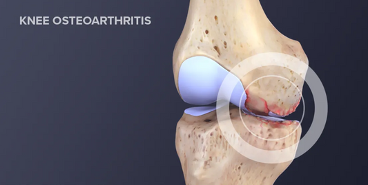 knee-osteoarthritis