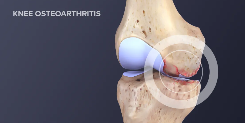Enhancing Knee Osteoarthritis Management: The Role of Foot Orthotics and Footwear - Diabetic Shoe - An Ortho Shoes Company