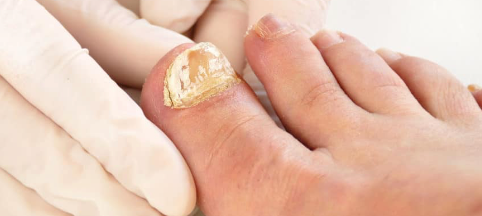 Is Nail Fungus Contagious? Understanding the Causes and Prevention - Diabetic Shoe - An Ortho Shoes Company