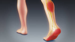 Understanding Nerve Swelling in the Foot