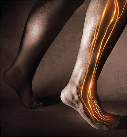 Understanding the Complexities of Neuropathy in the Distal Lower Extremities - Diabetic Shoe - An Ortho Shoes Company