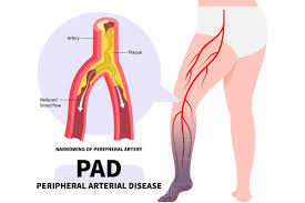 Understanding Paresthesia: Causes and Symptoms