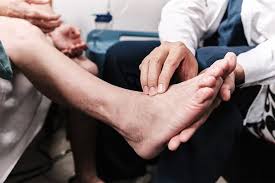 Effective Home Remedies for Peripheral Neuropathy