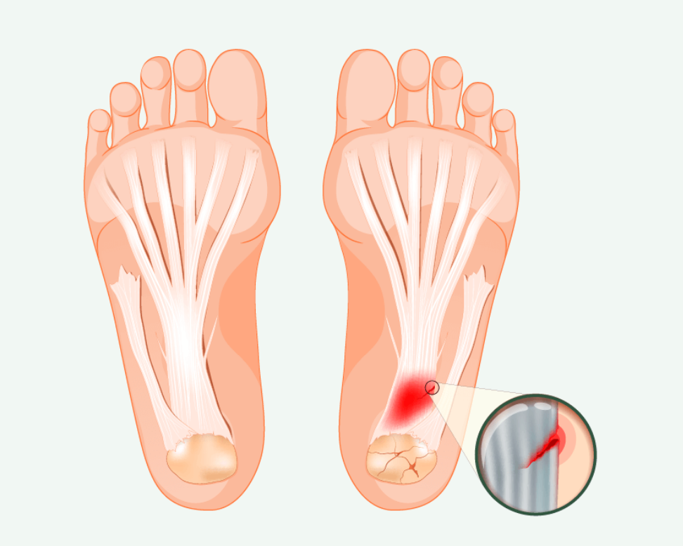 plantar-fasciitis