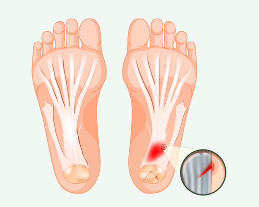 Understanding Plantar Fasciitis: Causes, Symptoms, and Treatment - Diabetic Shoe - An Ortho Shoes Company