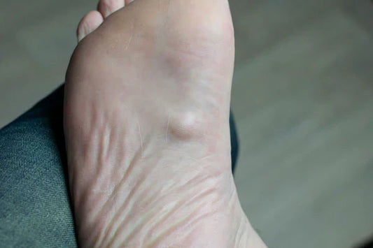 Painful Lump on Bottom of Foot Under Skin - Diabetic Shoe - An Ortho Shoes Company