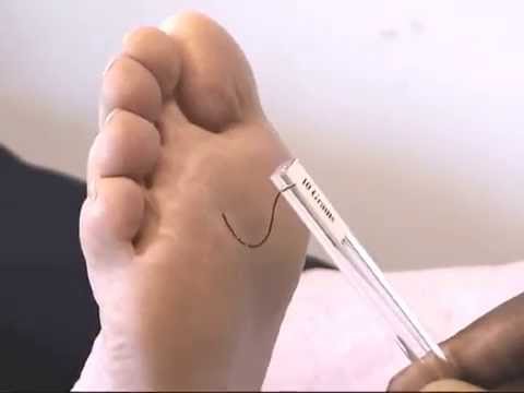 Assessing Sensory Perception in Diabetic Patients: The Semmes–Weinstein Monofilament Test - Diabetic Shoe - An Ortho Shoes Company