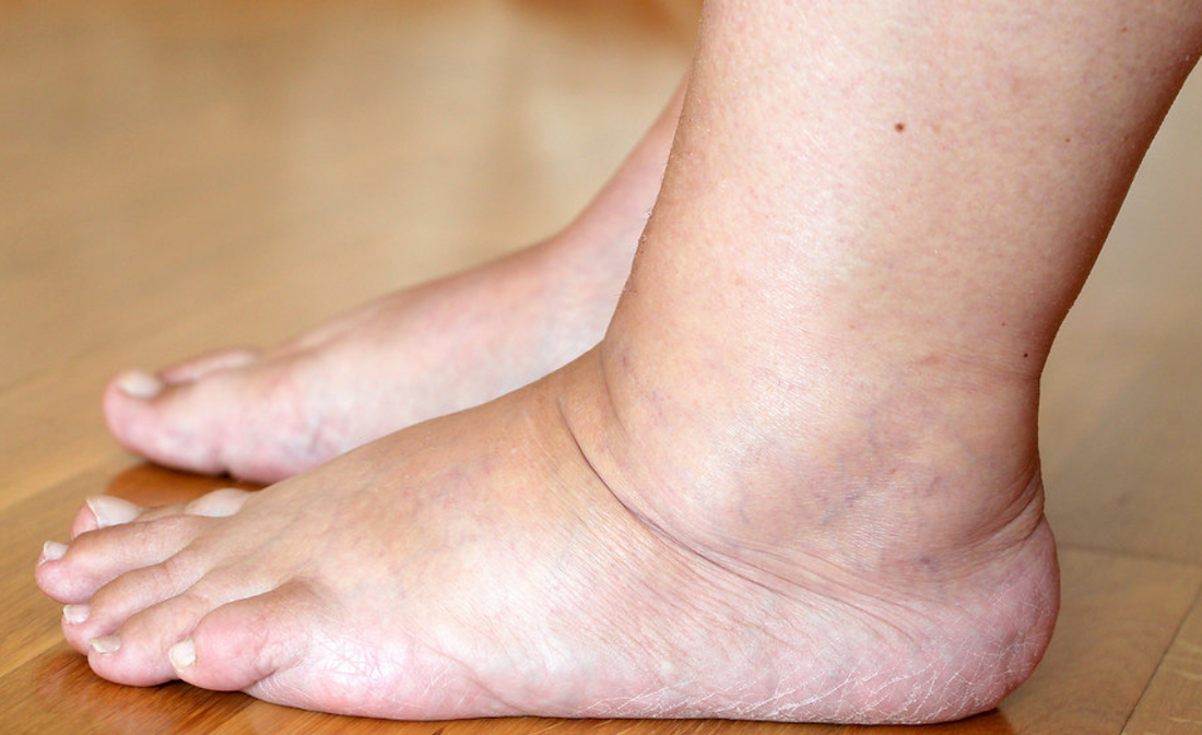 Effective Home Remedies for Swollen Feet in Diabetes - Diabetic Shoe - An Ortho Shoes Company
