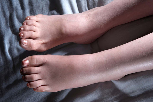 Is Swelling of the Legs Dangerous?
