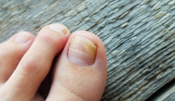 Battling Toenail Fungus: Causes, Challenges, and Treatment Options - Diabetic Shoe - An Ortho Shoes Company