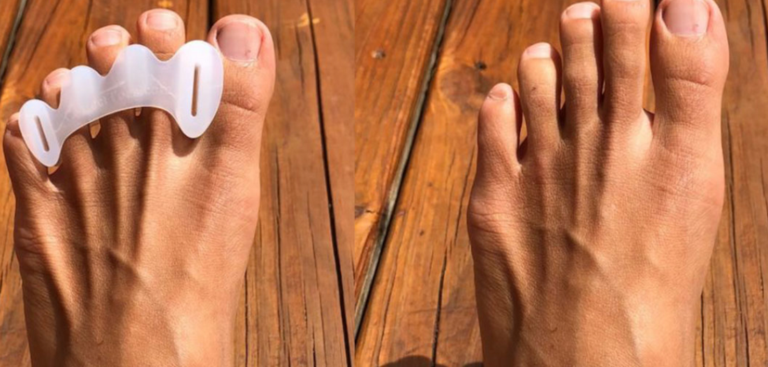 Understanding the Uses and Benefits of Toe Spacers: A Comprehensive Guide