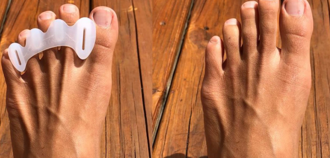 Understanding the Uses and Benefits of Toe Spacers: A Comprehensive Guide - Diabetic Shoe - An Ortho Shoes Company