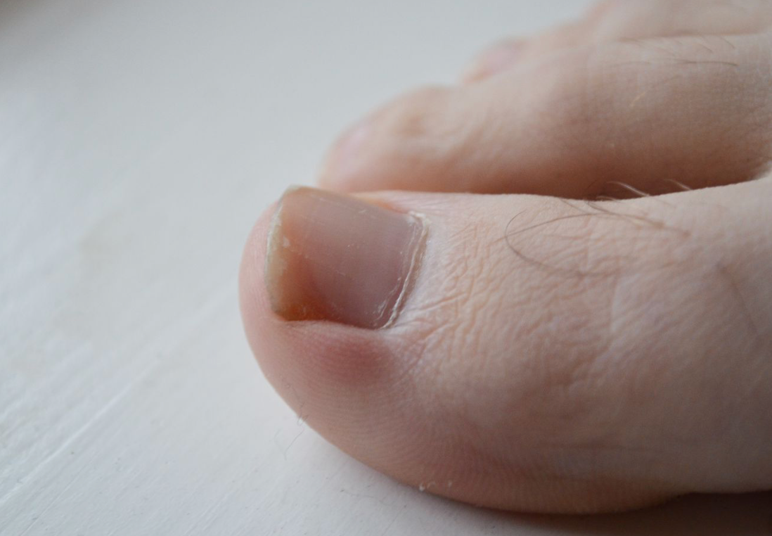 Decoding Your Health: What Your Toenails Reveal About Your Well-being