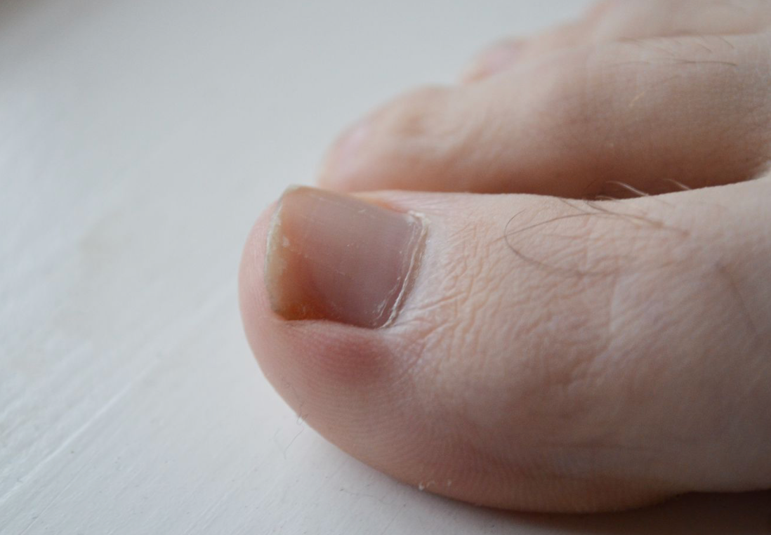 Decoding Your Health: What Your Toenails Reveal About Your Well-being - Diabetic Shoe - An Ortho Shoes Company
