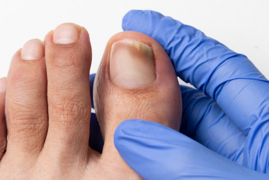 Foot Fungus: Understanding, Treating, and Preventing Toenail Infections