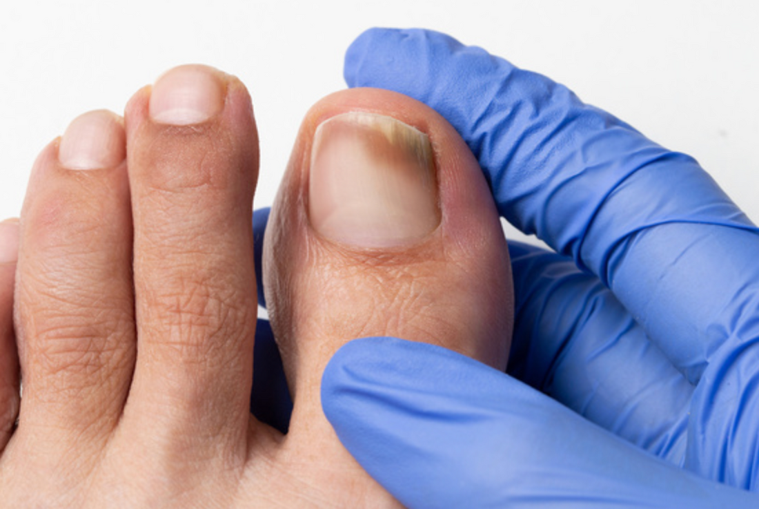 Foot Fungus: Understanding, Treating, and Preventing Toenail Infections - Diabetic Shoe - An Ortho Shoes Company