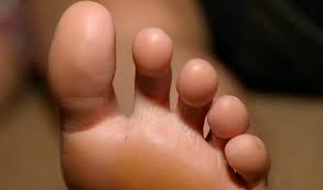 Understanding Large Fibre Neuropathy Symptoms and Treatments