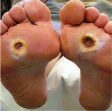Understanding Diabetic Foot: A Visual Guide - Diabetic Shoe - An Ortho Shoes Company