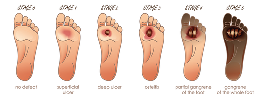 HOW SMALL FOOT INJURIES CAN ESCALATE WITHOUT PROPER FOOTWEAR? - Diabetic Shoe - An Ortho Shoes Company