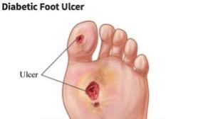 HOW DO DIABETIC SHOES HELP MANAGE FOOT ULCERS AND WOUNDS