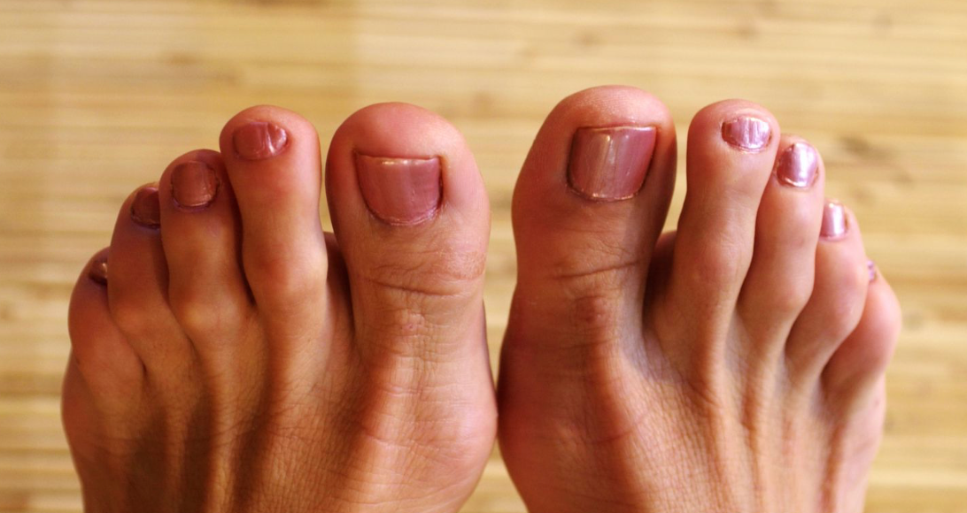 understanding- hammer-toe