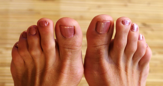Understanding Hammer Toe: Causes and Symptoms - Diabetic Shoe - An Ortho Shoes Company