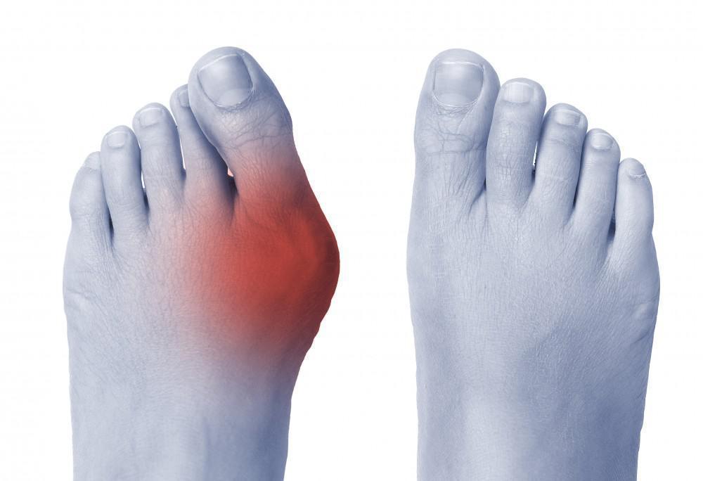 Stepping Towards Comfort: Understanding and Managing Bunions - Diabetic Shoe - An Ortho Shoes Company