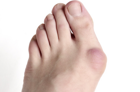 understanding-bunions