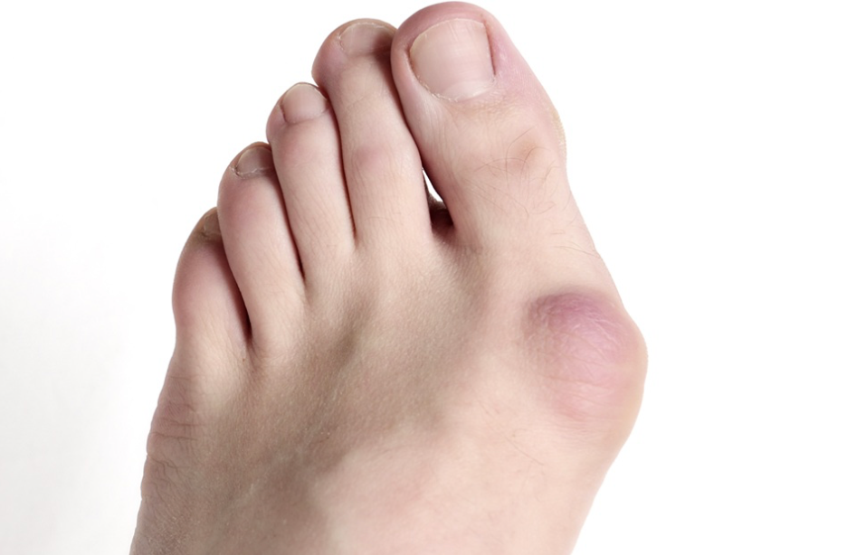 Understanding Bunions: Causes, Symptoms, and Treatment Options - Diabetic Shoe - An Ortho Shoes Company