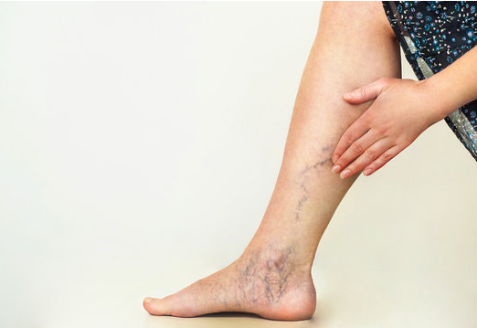 understanding-varicose-veins-causes-symptoms-and-solutions