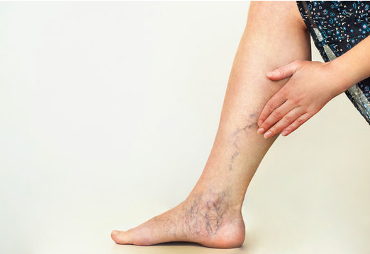 Understanding Varicose Veins: Causes, Symptoms, and Solutions - Diabetic Shoe - An Ortho Shoes Company
