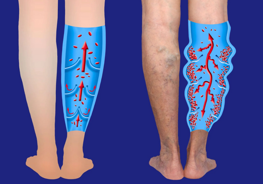 understanding-varicose-veins