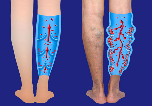 Understanding Varicose Veins: Causes, Symptoms, and Treatment - Diabetic Shoe - An Ortho Shoes Company