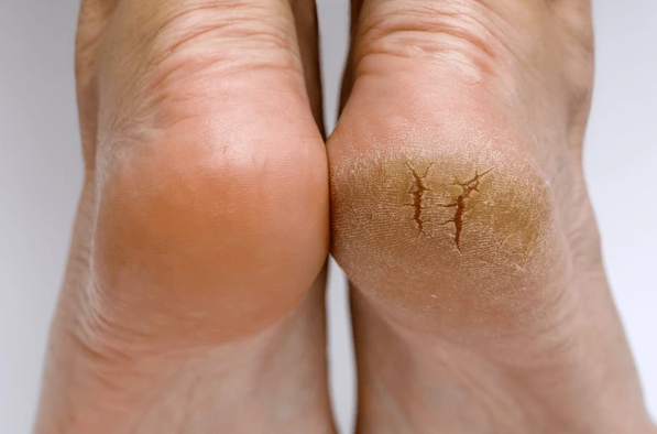 Unraveling the Impact of Neglecting Foot Health on Overall Well-being - Diabetic Shoe - An Ortho Shoes Company