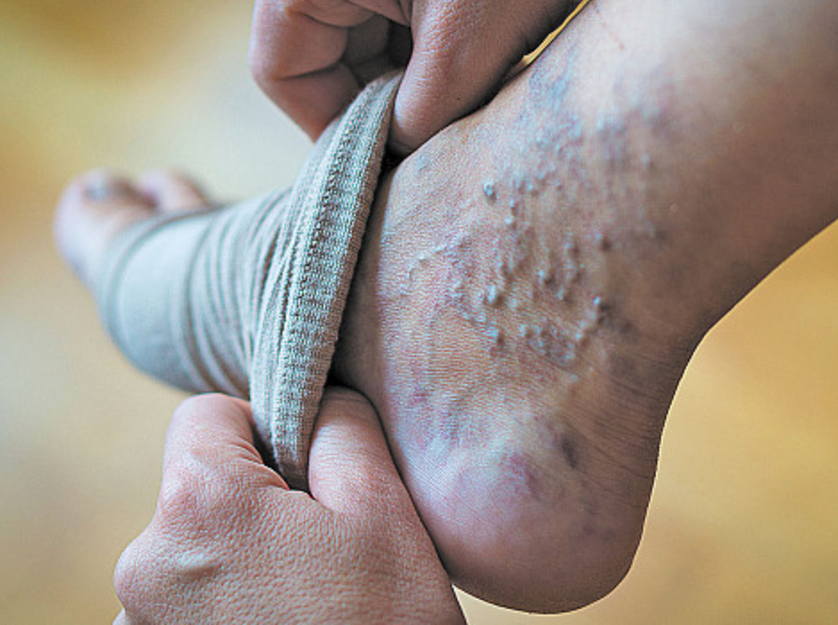 Top 4 Symptoms of Varicose Veins - Diabetic Shoe - An Ortho Shoes Company