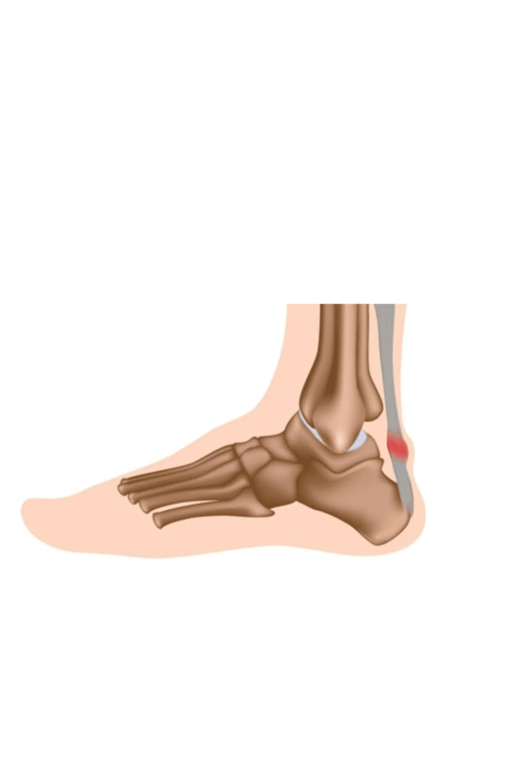 Achilles Tendonitis