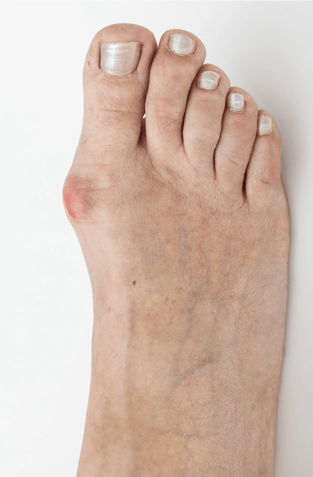 Bunions and Corn