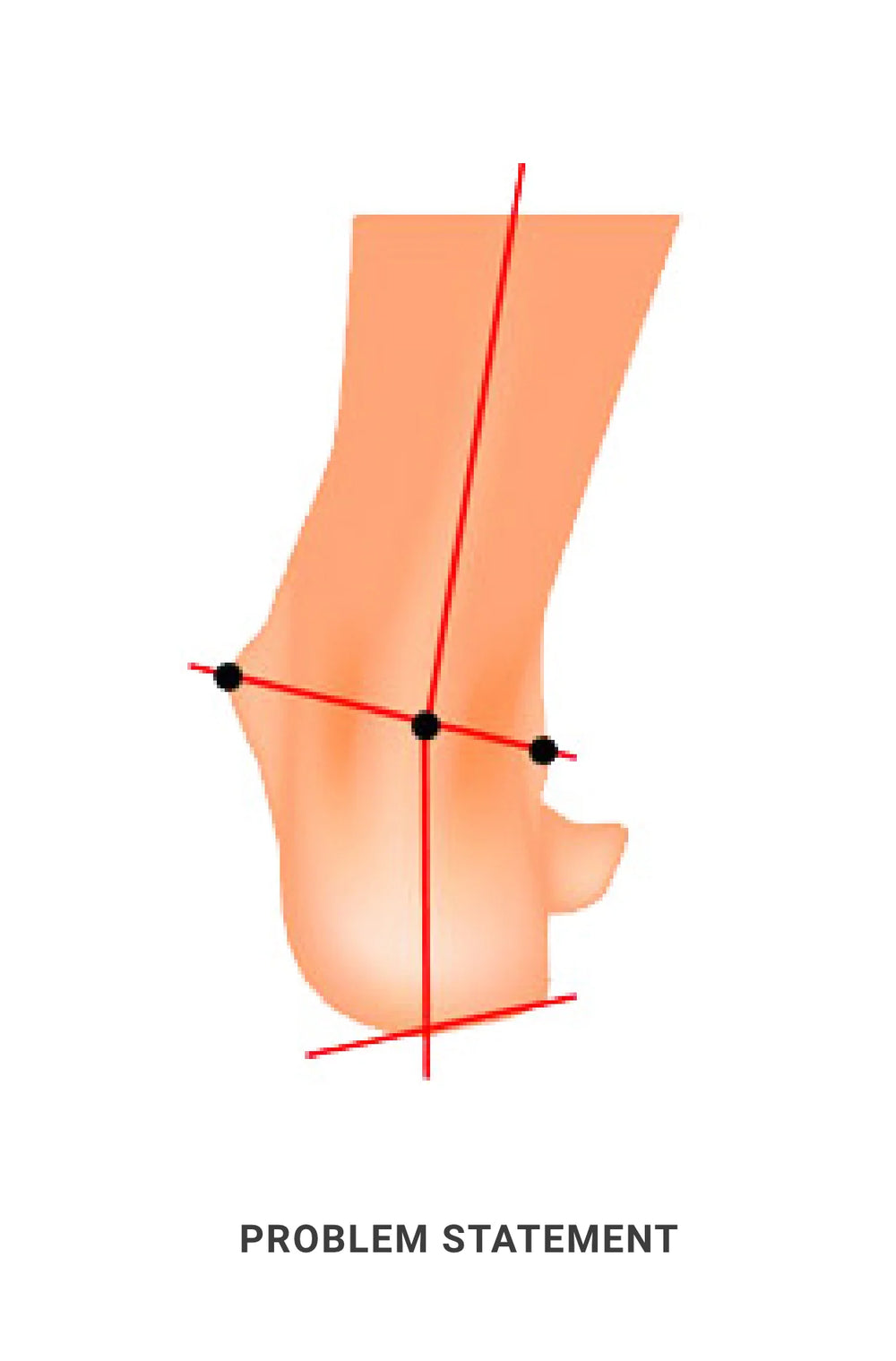 Overpronation