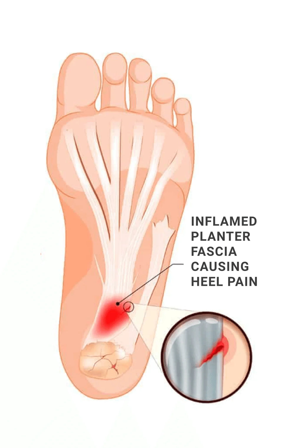 Plantar Fasciitis